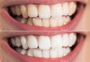 konya diş beyazlatma tedavisi