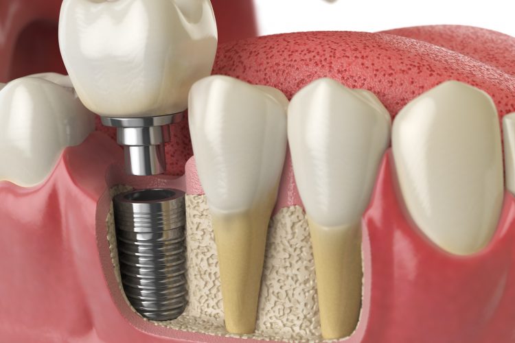 Konya implant